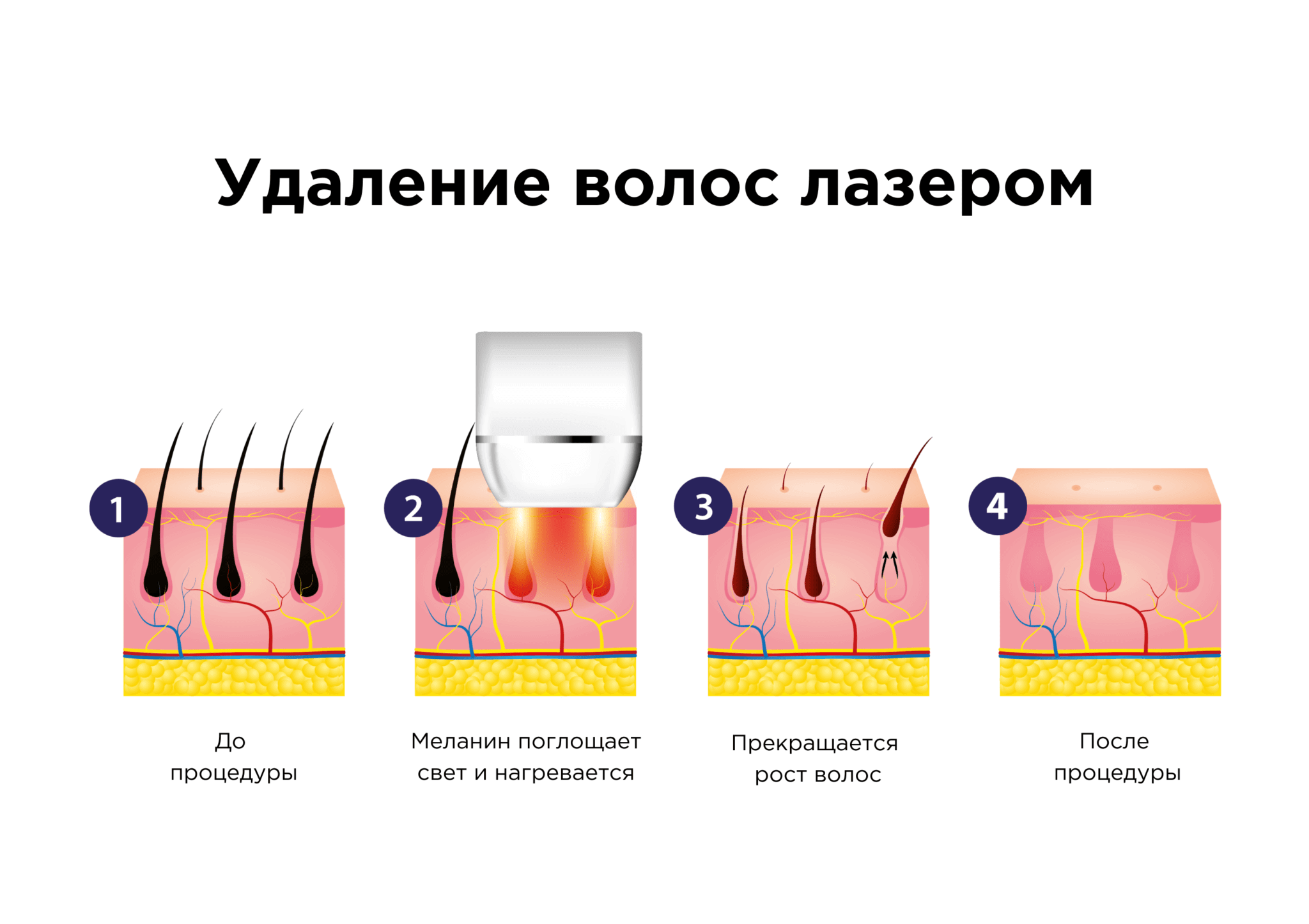 Интервал лазерной эпиляции